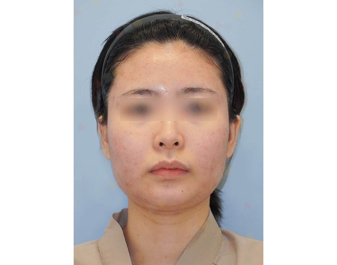 Woman with clear, smooth skin showing improvement.
