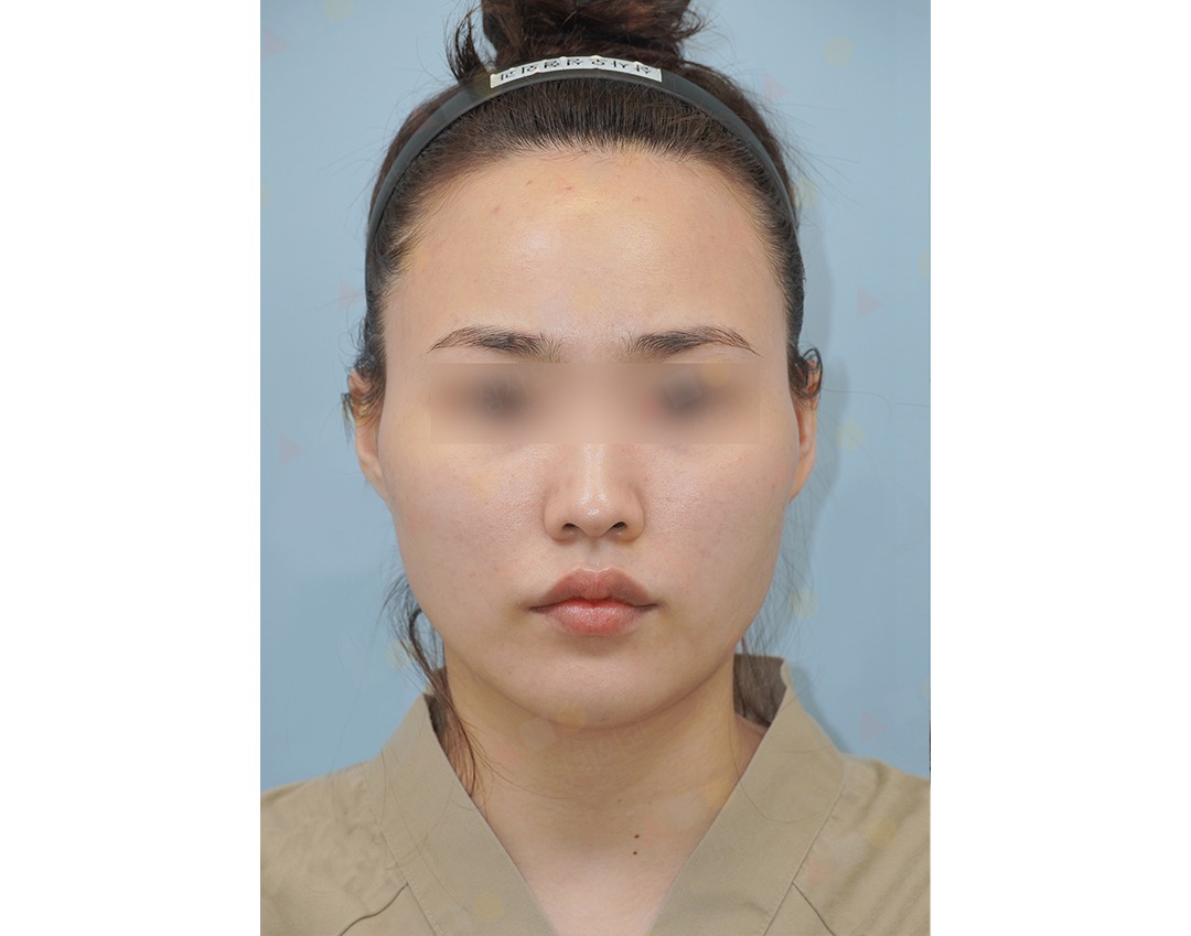 Person with clear skin and headband facing camera.