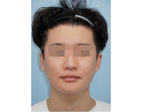 Person with blurred eyes facing forward, wearing hairband.