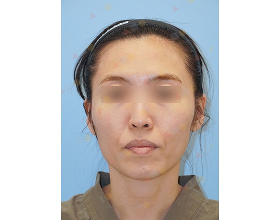 Unidentified person with blurred eyes and headband.