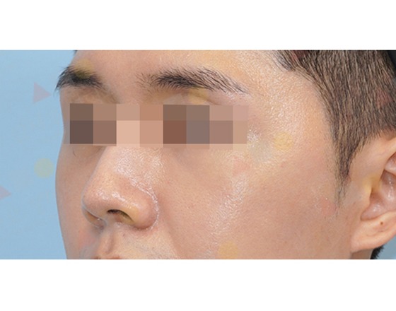 Close-up of person's face with blurred eyes.