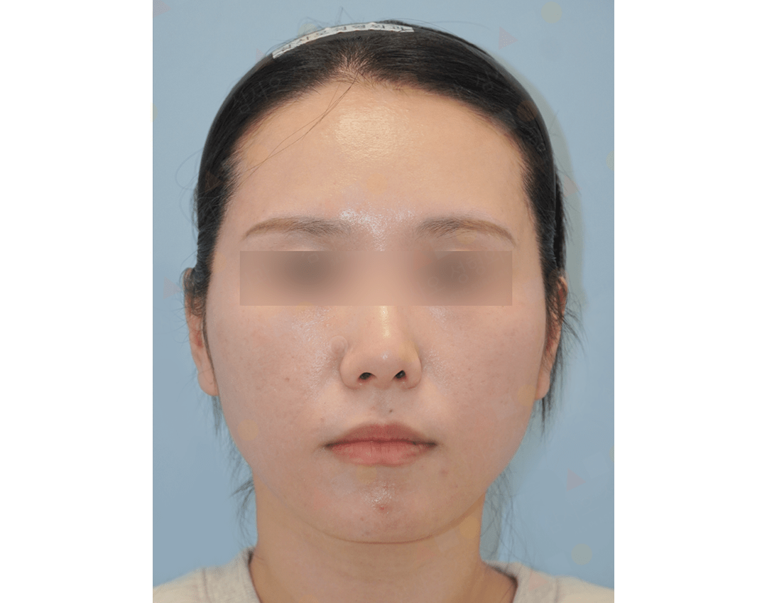 Front view of woman's face with blurred eyes.