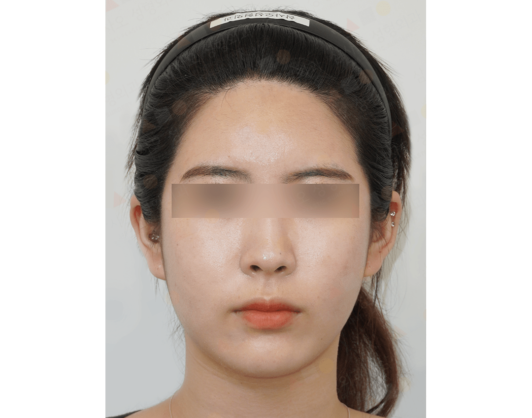 Front view of person's face with blurred eyes.