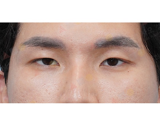 Close-up of person's eyes with uneven eyelids.