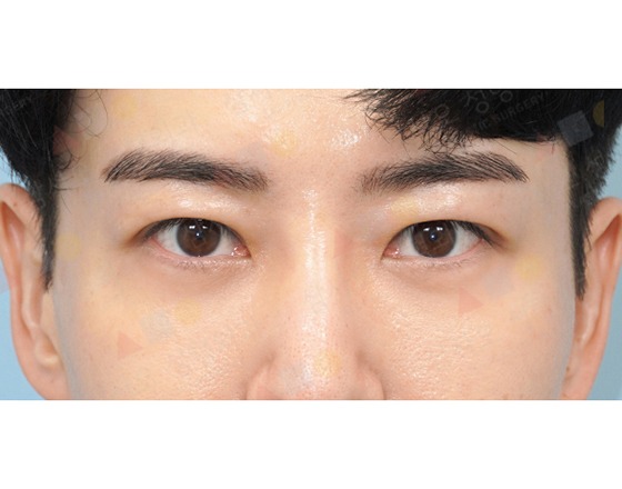 Close-up of person with clear skin and eyebrows.