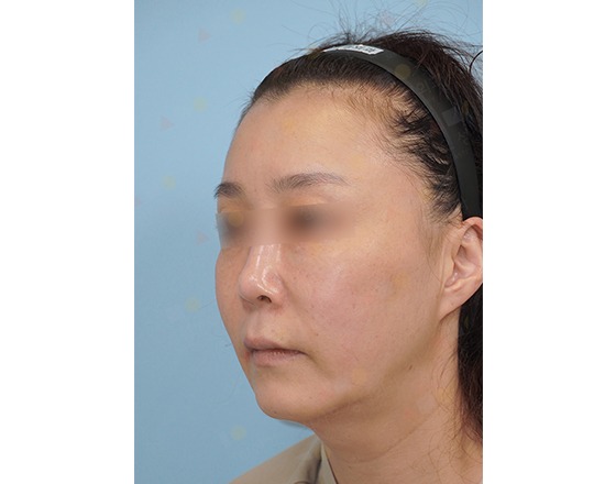 Woman with facial discoloration, side profile view.
