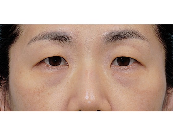 Close-up of person's eyes and upper face