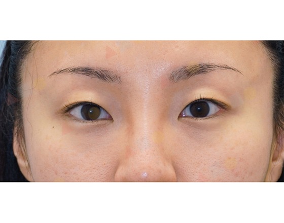 Close-up of person with heterochromia eyes.