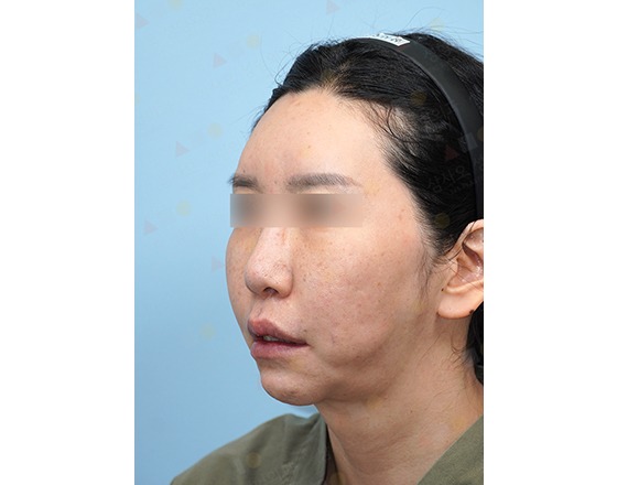 Woman before cosmetic procedure, side profile view.
