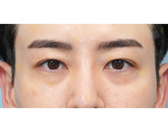 Close-up of person's eyes with clear eyebrows