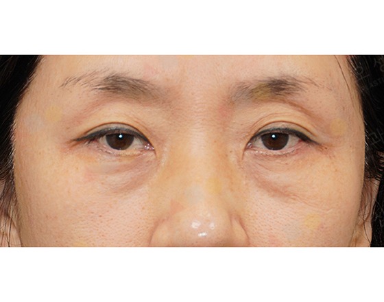 Close-up of person's eyes with neutral expression.