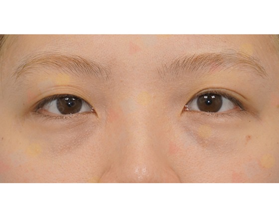 Close-up of person's eyes with skin imperfections.