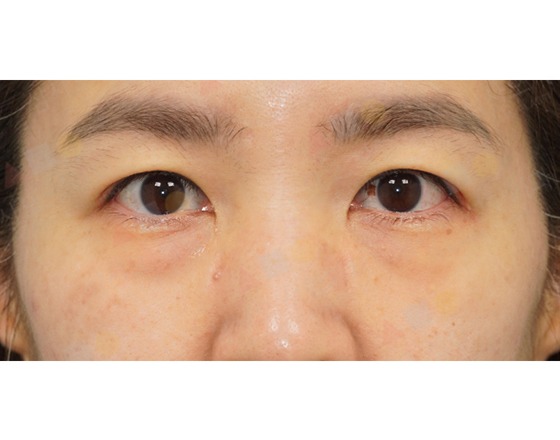 Close-up of human eyes and eyebrows.