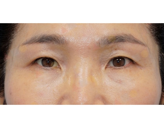 Close-up of eyes with skin discoloration spots.