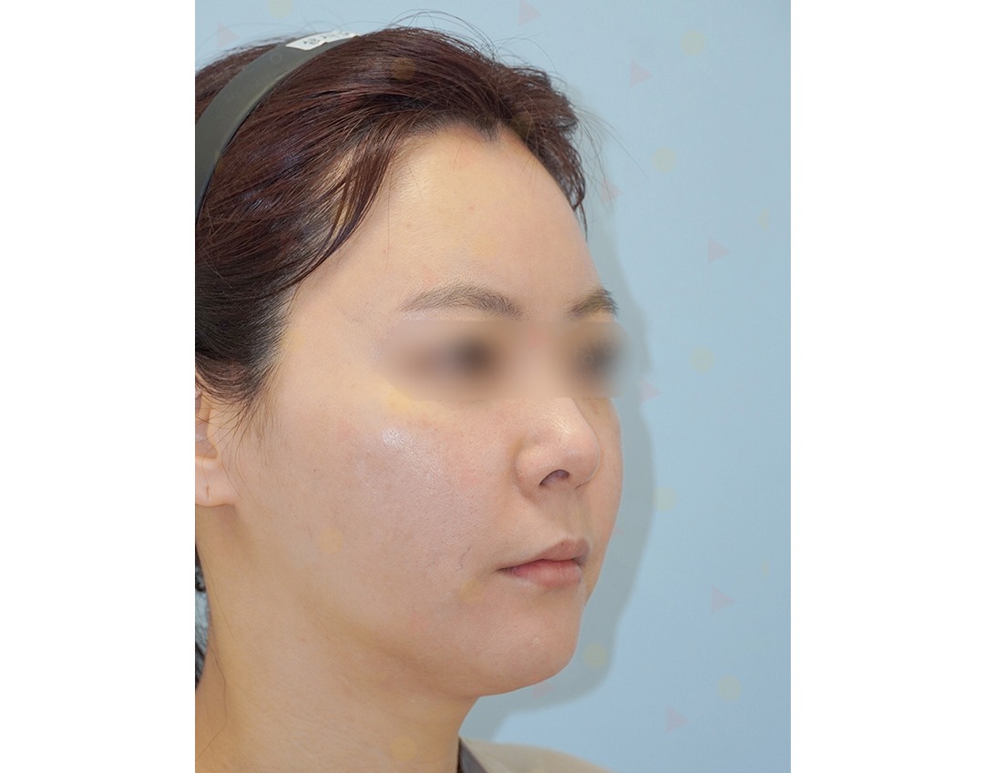Woman's side profile, before cosmetic procedure