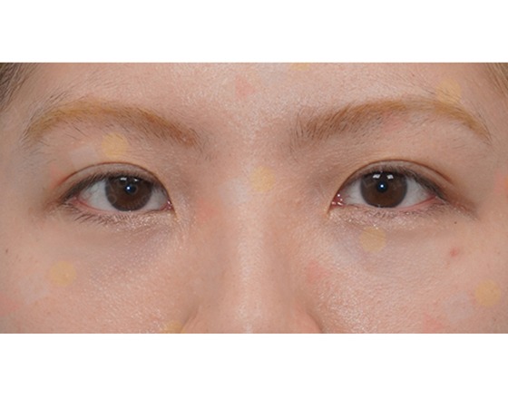 Close-up of person's eyes with symmetrical features.