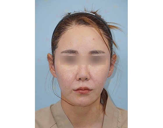 Person's face with blurred eyes, neutral expression.