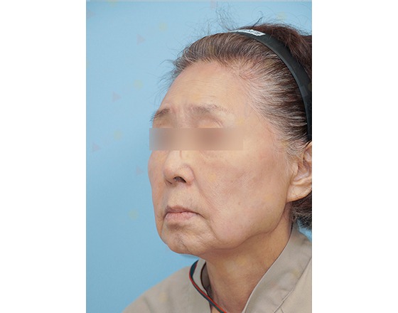 Elderly person with headband, blurred eyes, neutral expression.