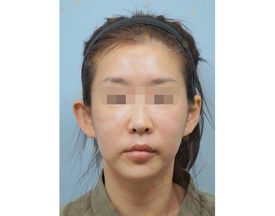 Person with headband, front view, blurred eyes.