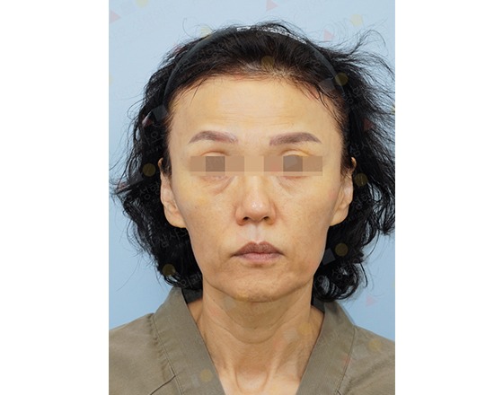 Person with blurred eyes facing camera