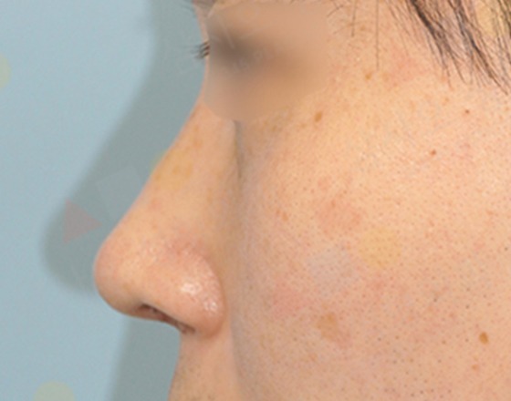 Close-up of facial freckles and skin texture.