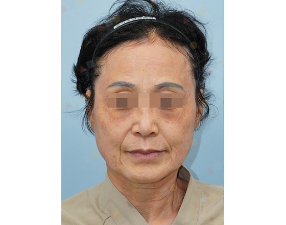 Person with blurred eyes facing front