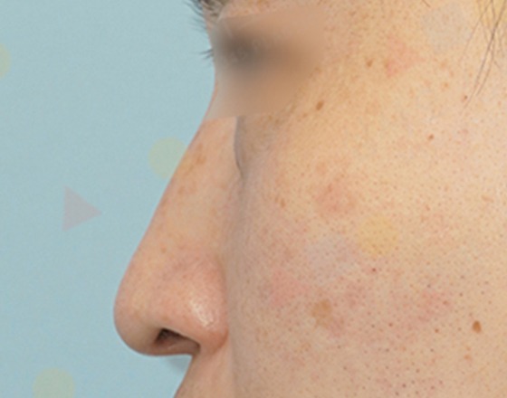 Close-up of skin with acne marks on face.