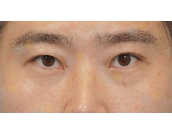 Close-up of person's eyes and forehead.