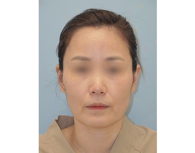 Person with blurred eyes, neutral expression