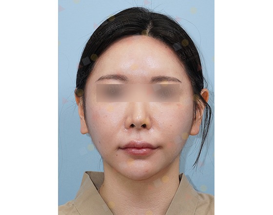 Person with eyes blurred, neutral expression.