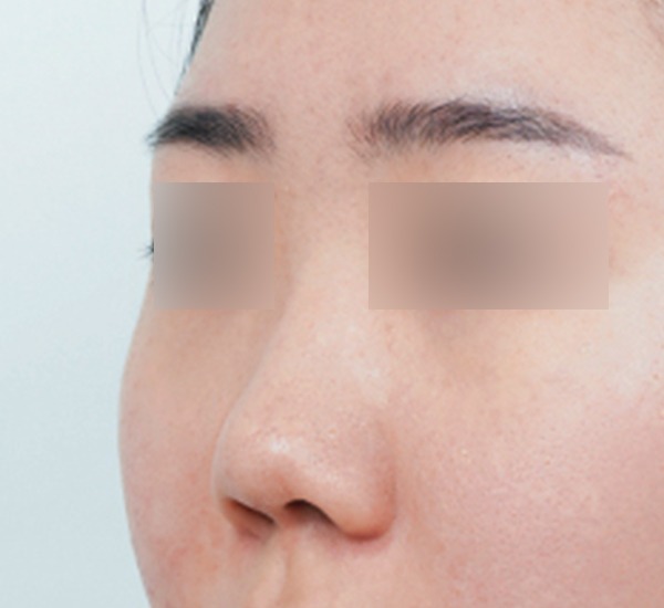 Close-up of person's face showing skin texture.