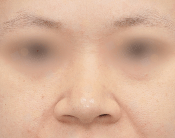 Close-up of a person's nose and forehead skin