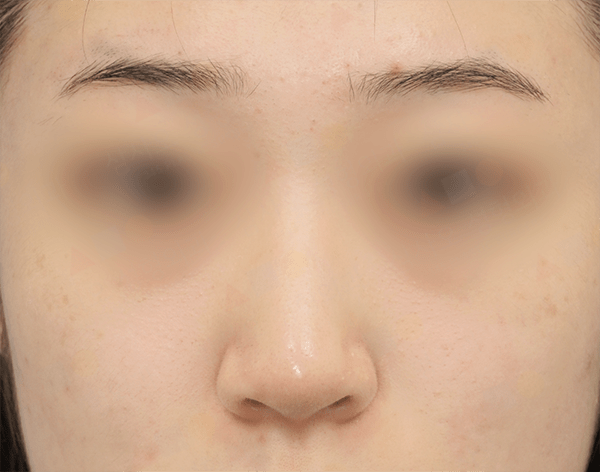 Close-up of a person's face with skin texture.