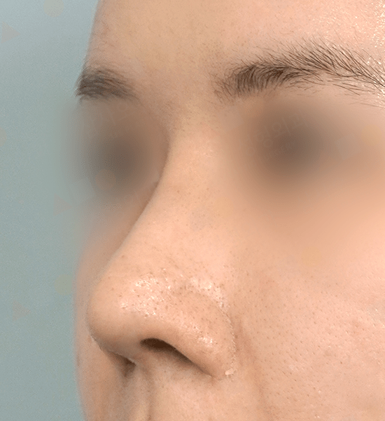 Close-up of skin with large pores