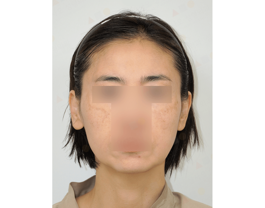 Woman with blemished skin, blurred features