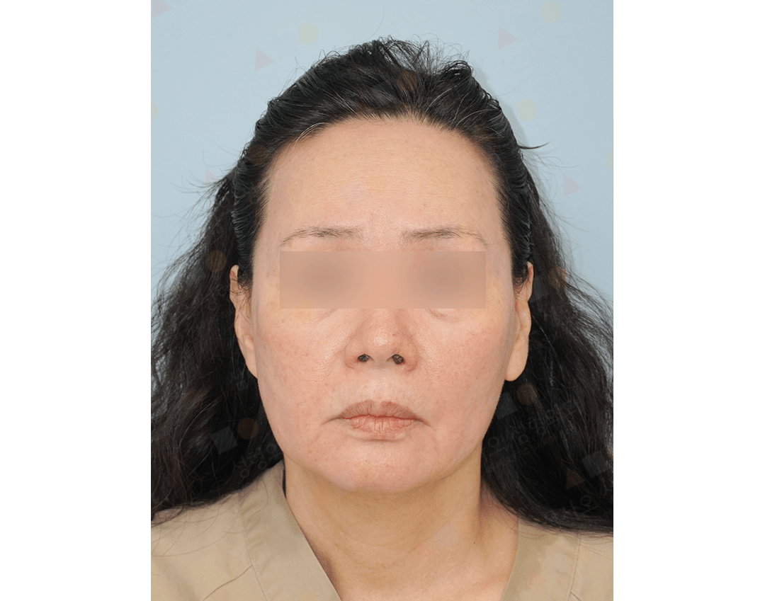 Portrait of a person with blurred eyes.