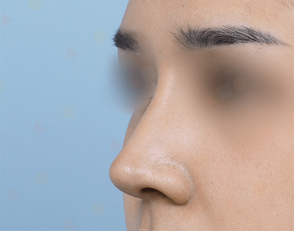 Close-up of a person's nose and blurred eyes.